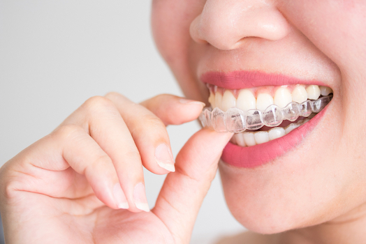 invisalign albury