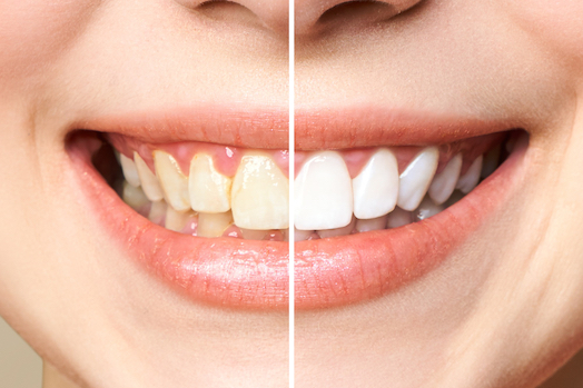 teeth whitening albury