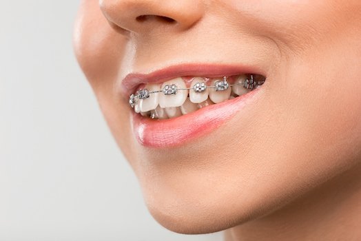 braces care albury