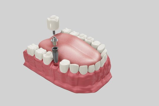 dental implants blurb albury