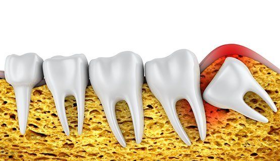 wisdom teeth extraction albury