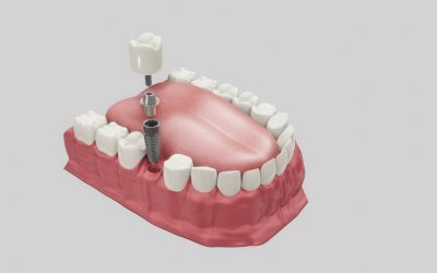 Restoring Confidence and Functionality: The Power of Dental Implants