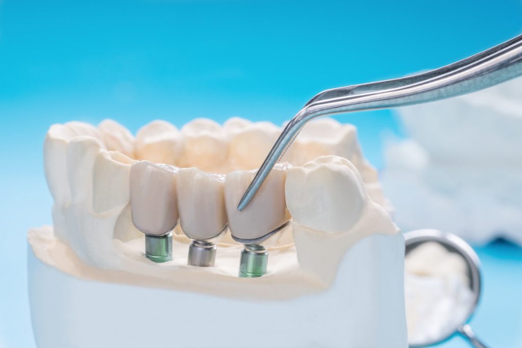 dental crowns vs bridges a comparison of restorative options