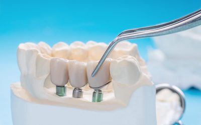 Dental Crowns vs Bridges: A Comparison of Restorative Options