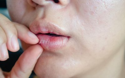 Dry Mouth Treatment and Prevention Tips for Better Oral Health