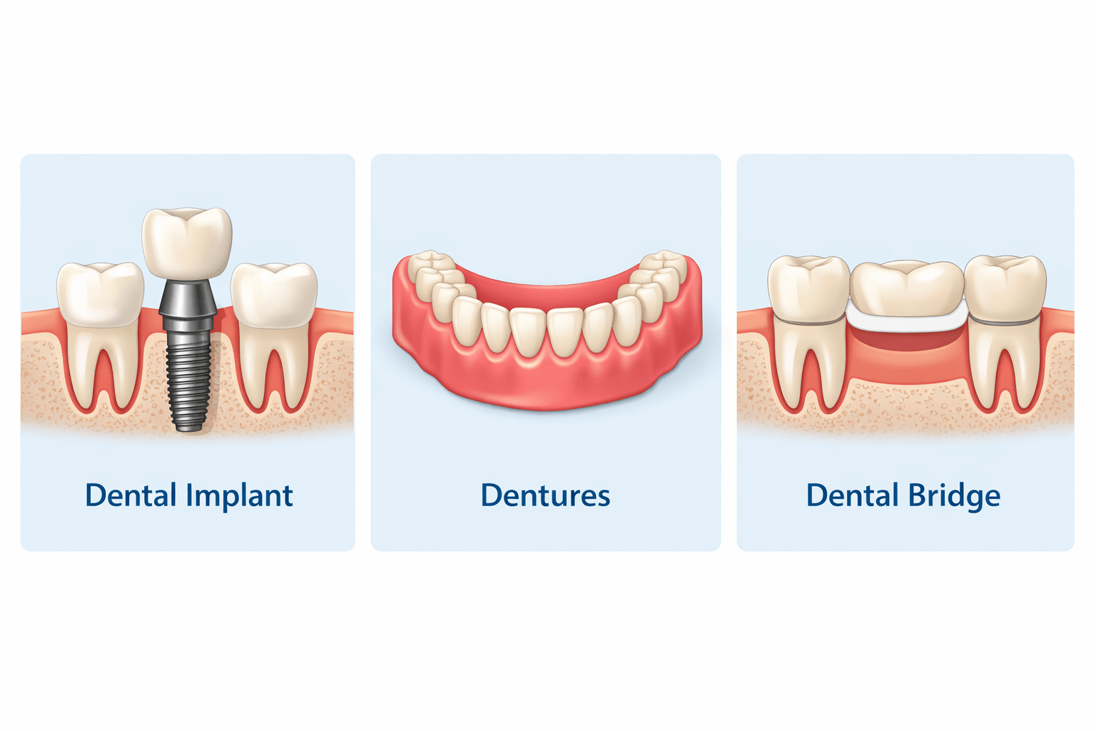 Comparison of dental implants, dentures and dental bridges for missing teeth replacement in Albury