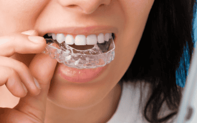 Invisalign in Albury: What to Expect and How It Works