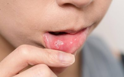 Mouth Ulcers: Causes, Treatment and When to See Your Dentist