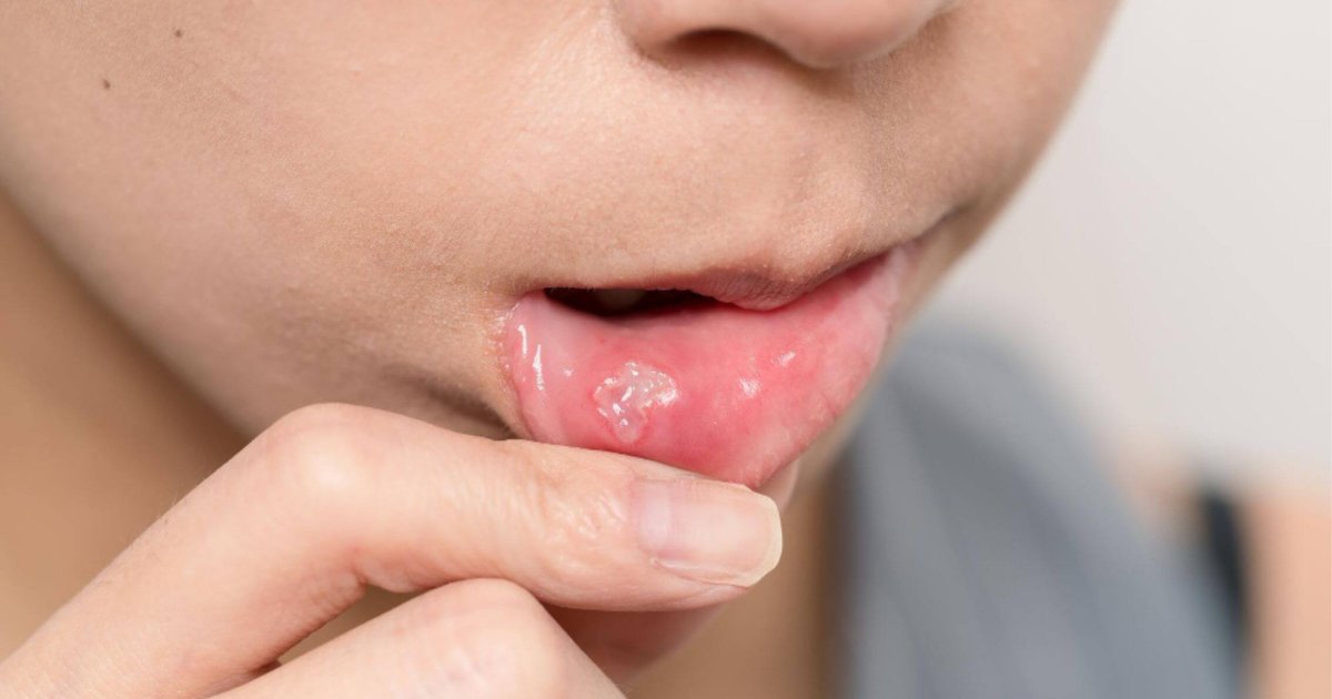 Close-up of a mouth ulcer on the inner cheek in Albury