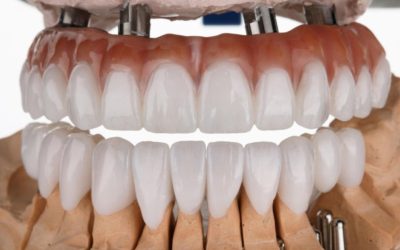 All-on-4 and Full-Arch Implants: What the Treatment Involves