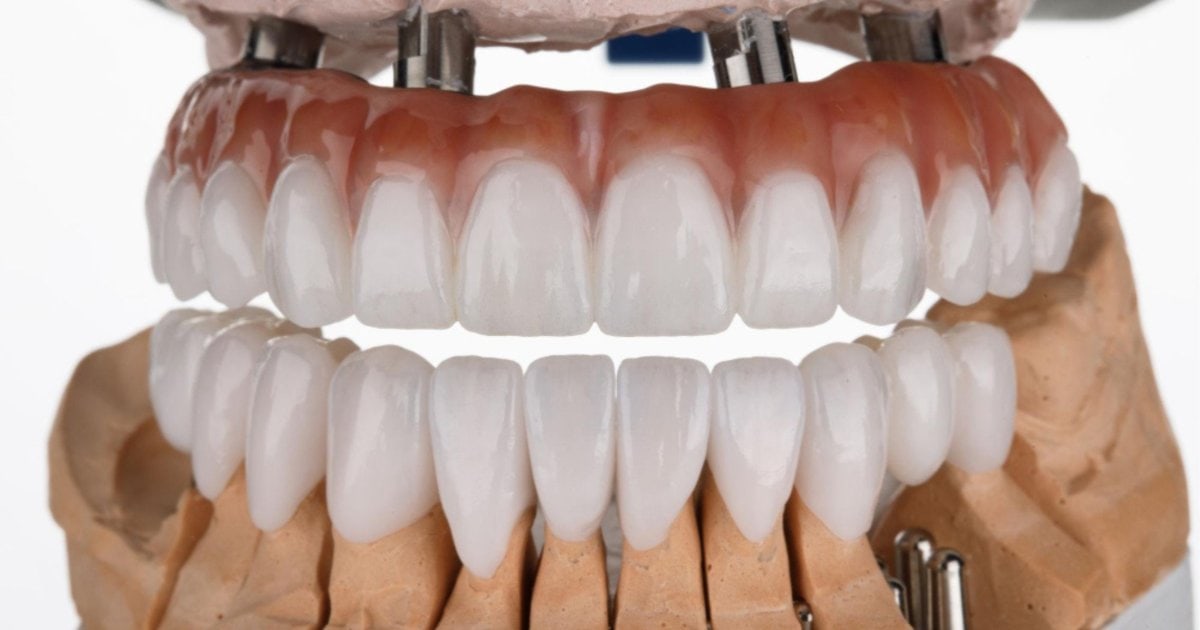 dental model showing a full-arch implant-supported prosthesis in Albury